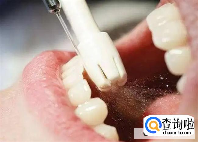 洗牙后可以吃咸鸭蛋吗