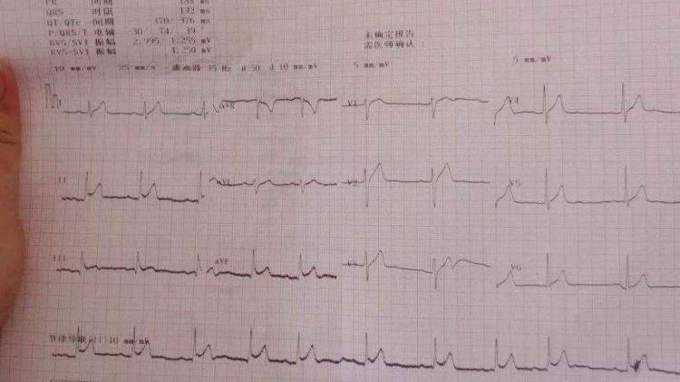 早搏是什么意思