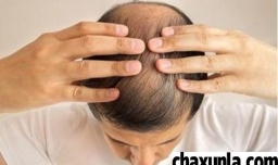 掉头发跟肾虚有关系吗