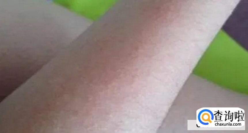 怎么做好皮炎的预防