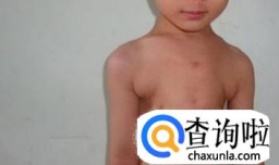 如何治疗佝偻病