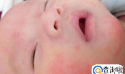 孩子过敏起疙瘩怎么办