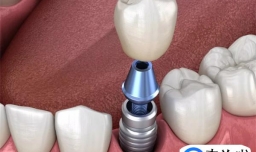 种植牙的全部过程是怎样的 种植牙有什么风险和后遗症