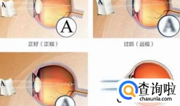 如何预防儿童屈光不正