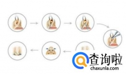 隆鼻的原理是什么 隆鼻有哪些危害