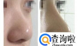 假体隆鼻哪种材料最好？