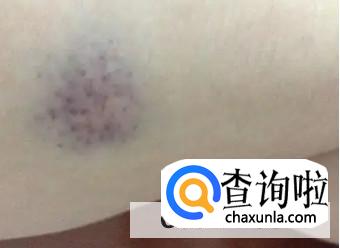 身上无缘无故出现淤青是什么原因