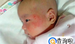 宝宝起热疙瘩怎么办