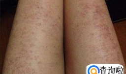 刮痧瘦腿方向是从上往下还是从下往上？