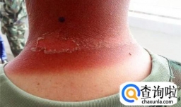 被阳光晒伤脸刺痛怎么办？可以敷面膜吗？