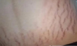 妊娠纹有横向的吗