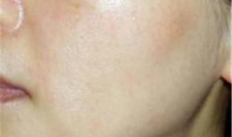 夏天脸部冒油怎么办