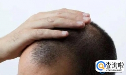 新冠会不会造成永久性脱发