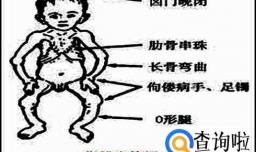 如何定义佝偻病 佝偻病有哪些症状
