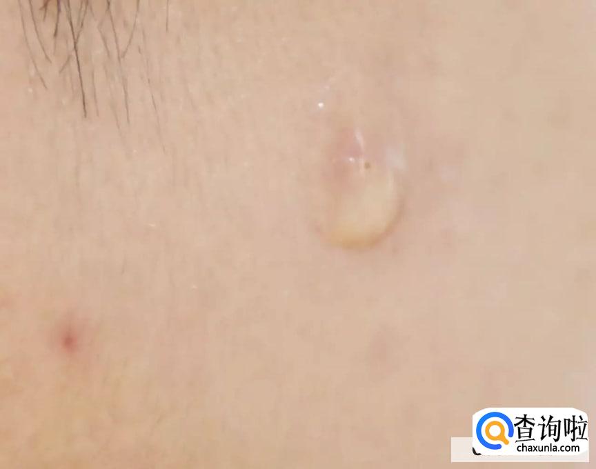 怎样消除痘印美白