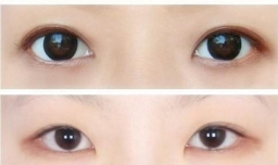 微创双眼皮手术