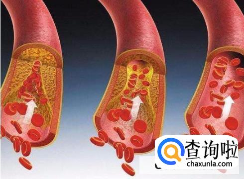 如何预防肺动脉栓塞