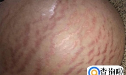 妊娠纹几个月开始长（妊娠纹第几个月开始出现）