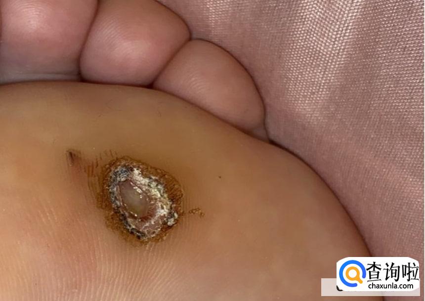 为什么脚上会长鸡眼