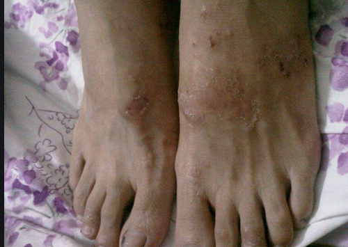 真菌感染怎么办