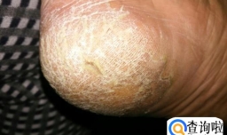 脚后跟干裂起硬皮是什么原因