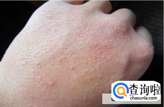 发生食物过敏反应的急救措施