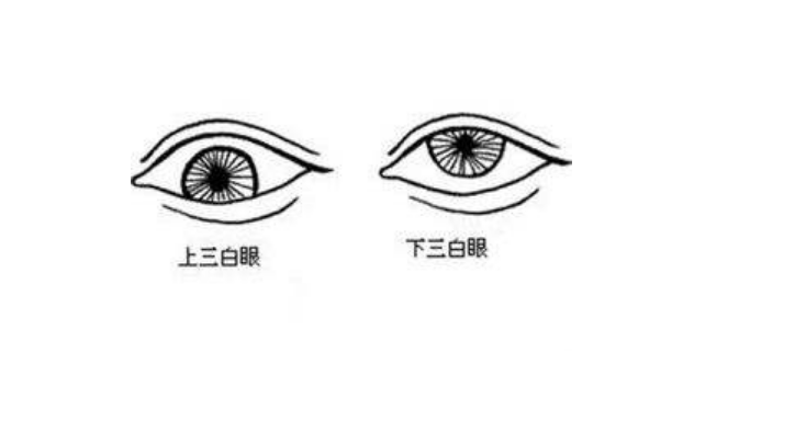 什么是三白眼