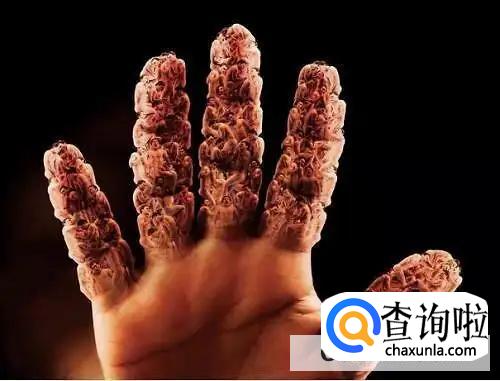 如何有效地对痛风进行护理