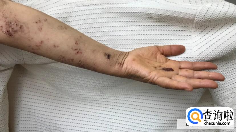 怎么诊断带状疱疹？