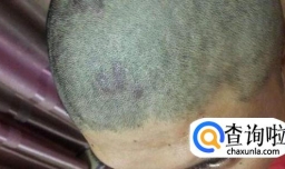 头皮脂溢性皮炎可以根治吗