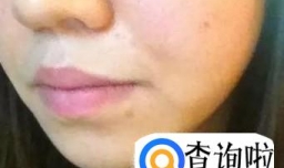 亲身经历：点阵激光治痘坑效果怎么样？