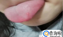 舌头起泡的原因