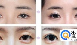 埋线双眼皮手术过程是怎么做的？