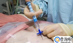 做骨髓穿刺有后遗症吗