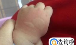 夏季给宝宝驱蚊有哪些小妙招？