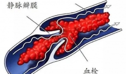 长期久坐会得肺栓噻？
