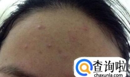 额头上长痘痘怎么办？祛除额头痘小妙招来帮你