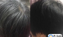 艾叶泡脚一年白头发变黑了是真的吗