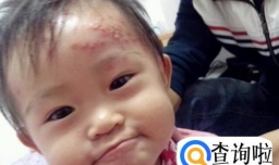 宝宝身上起的什么疙瘩(宝宝起疙瘩的可能)