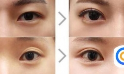 怎样积极面对整容失败？