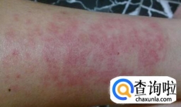 艾灸之后有红疹是过敏还是排毒反应？