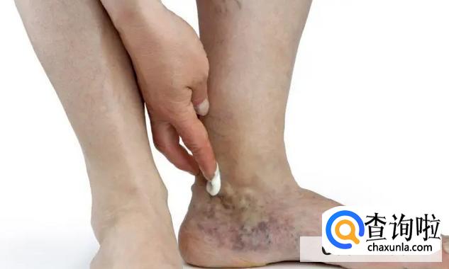 静脉曲张是日常哪些习惯造成的