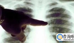 家属新冠肺炎白肺会传染给我吗