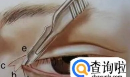 开眼角术后疤痕多久才能消失