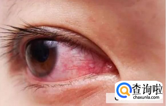 隐形眼镜容易脱落怎么办