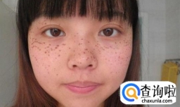 如何快速美白祛斑的方法