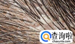 如何识别头上是否有螨虫