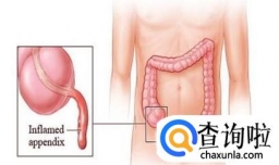 阑尾炎一定要做手术吗？