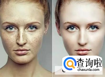 有哪些祛除雀斑的好方法