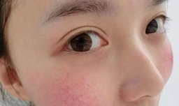 针对面部红血丝的民间小偏方